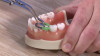 Triodent Miyasaki Ring Placement