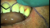 Ultrapak Veneer Technique Video