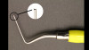 Ribbond Reinforced Large Composite Restorations