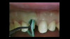 Ultrapak Double Cord Technique Video